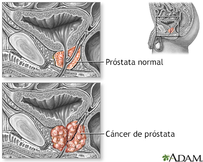 disuria en cáncer de próstata)