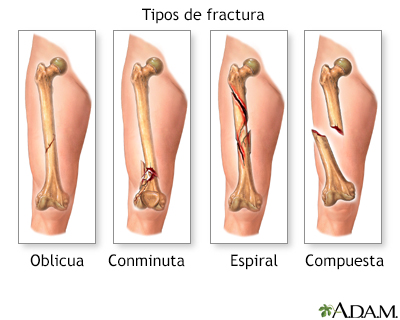 Tipos de fractura (1)