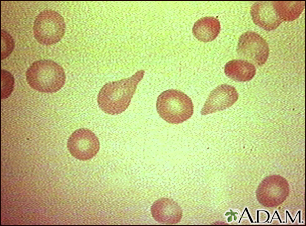 Glóbulos rojos sanguíneos en forma de lágrima