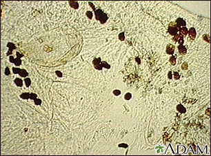 Microfotografía de las heces del ácaro de la escabiosis