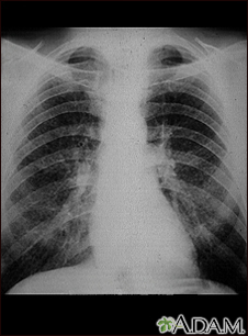 Pulmones de un trabajador del carbon - radiografía de tórax