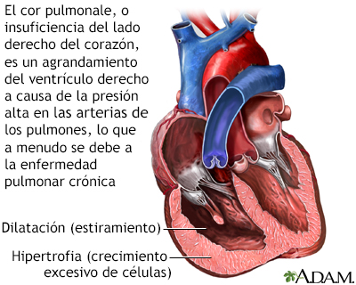 Cor pulmonale