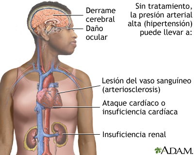 Hipertensión sin tratamiento