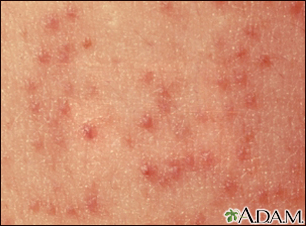 Primer plano de la queratosis pilaris