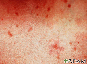 Urticaria pigmentosa - vista de cerca