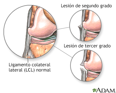 Lesión del ligamento colateral lateral