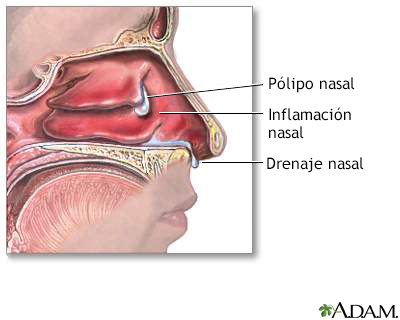 Pólipos nasales