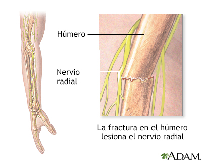 Disfunción del nervio radial